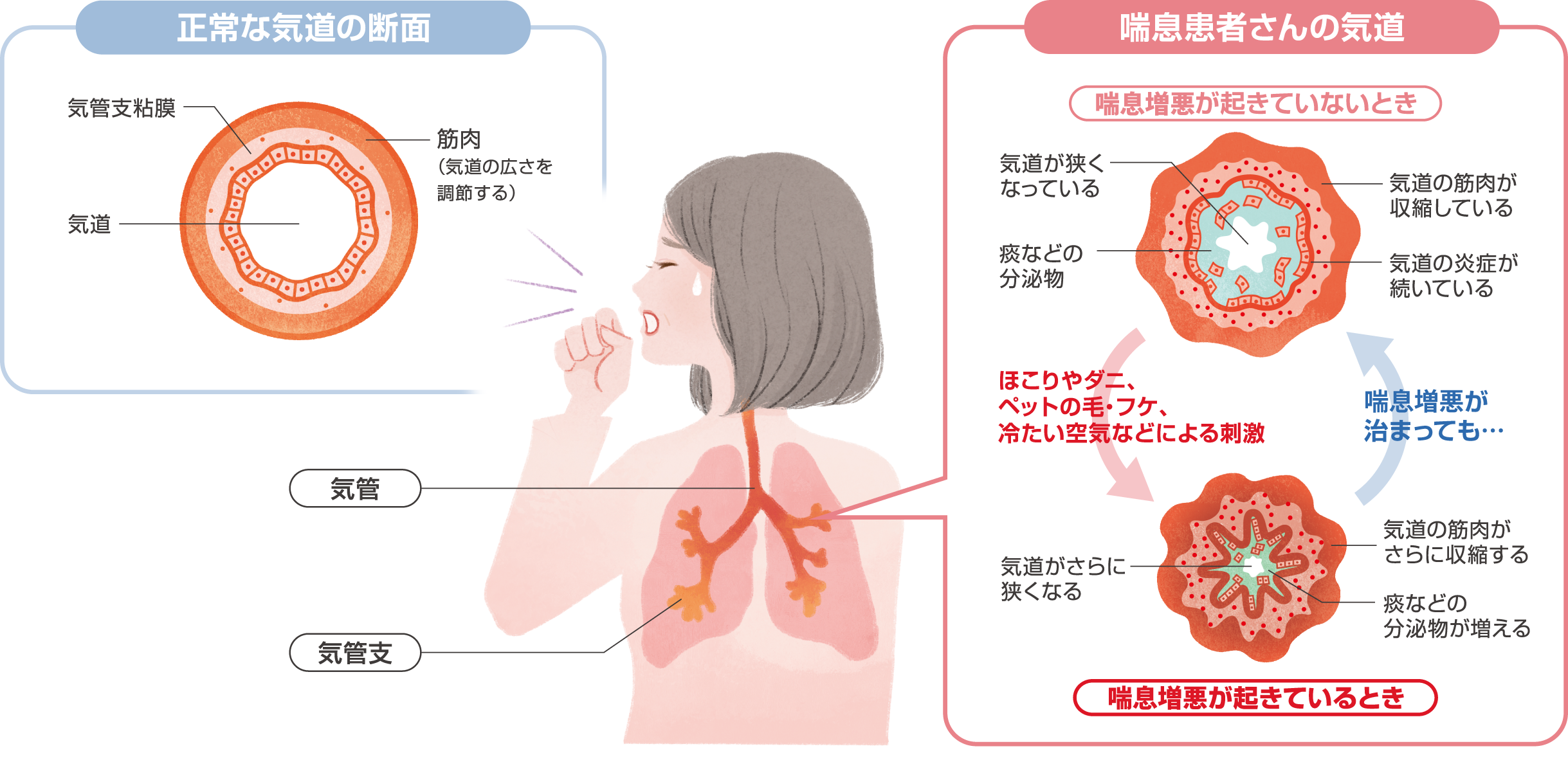 気管支 喘息 について 誤っ て いる の は どれ か